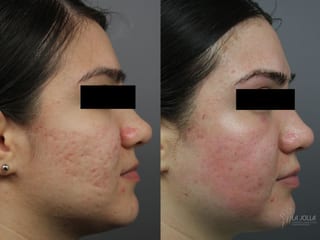 Before and after Acne Scars: Subcision case 36222 - Angle 1