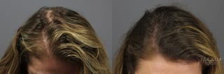 Before and after PRP (Platelet-Rich Plasma) case 36224 - Angle 1