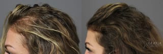 Before and after PRP (Platelet-Rich Plasma) case 36224 - Angle 2