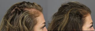 Before and after PRP (Platelet-Rich Plasma) case 36224 - Angle 3