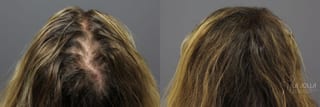 Before and after PRP (Platelet-Rich Plasma) case 36224 - Angle 4