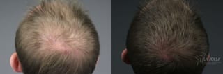 Before and after PRP (Platelet-Rich Plasma) case 36237 - Angle 2