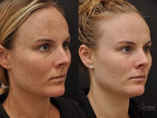 Before and after Chemical Peel case 36241 - Angle 3