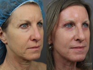 Before and after SP Dynamis case 36242 - Angle 2