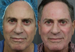 Before and after Ablative Laser Treatment case 36243 - Angle 1