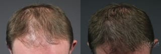 Before and after Hair Restoration case 36244 - Angle 1