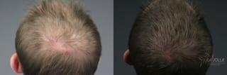Before and after Hair Restoration case 36244 - Angle 2
