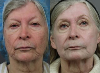 Before and after Ablative Laser Treatment case 36253 - Angle 1