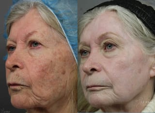 Before and after Ablative Laser Treatment case 36253 - Angle 2