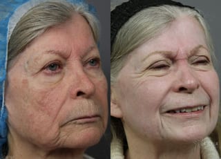 Before and after Ablative Laser Treatment case 36253 - Angle 3