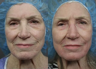 Before and after Ablative Laser Treatment case 36254 - Angle 1