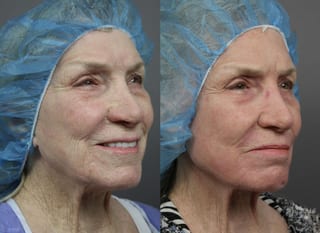 Before and after Ablative Laser Treatment case 36254 - Angle 3