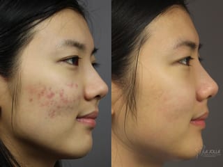 Before and after Fraxel® case 36260 - Angle 1
