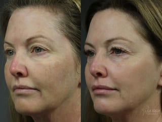 Before and after Fraxel® case 36261 - Angle 1