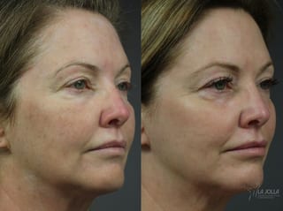 Before and after Fraxel® case 36261 - Angle 2