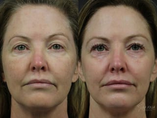 Before and after Fraxel® case 36261 - Angle 3