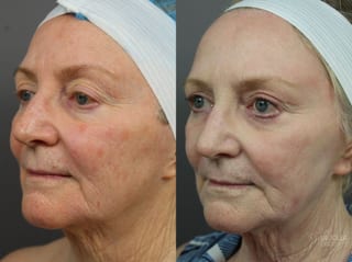 Before and after SP Dynamis case 36262 - Angle 1