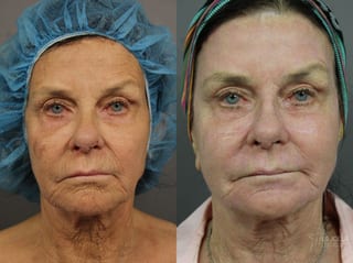 Before and after Ablative Laser Treatment case 36263 - Angle 1