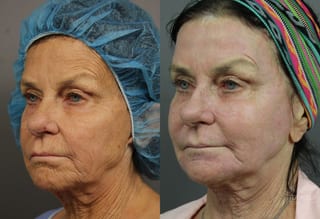 Before and after Ablative Laser Treatment case 36263 - Angle 3