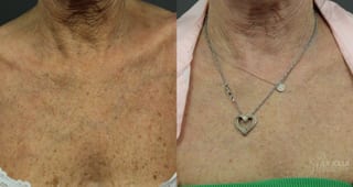 Before and after Ablative Laser Treatment case 36263 - Angle 4