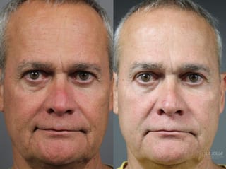 Before and after Sculptra® case 36264 - Angle 1