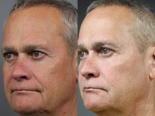 Before and after Sculptra® case 36264 - Angle 2