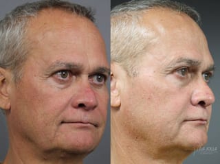 Before and after Sculptra® case 36264 - Angle 3