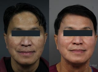 Before and after Chemical Peel case 36270 - Angle 1