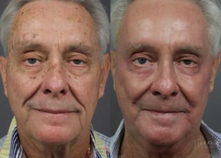 Before and after Ablative Laser Treatment case 36279 - Angle 1