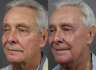 Before and after Ablative Laser Treatment case 36279 - Angle 3