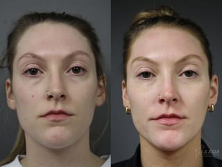 Before and after Sculptra® case 36282 - Angle 1