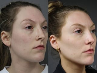 Before and after Sculptra® case 36282 - Angle 2