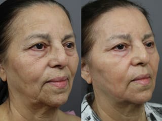 Before and after SP Dynamis case 36283 - Angle 1
