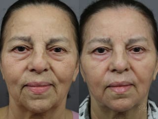 Before and after SP Dynamis case 36283 - Angle 2