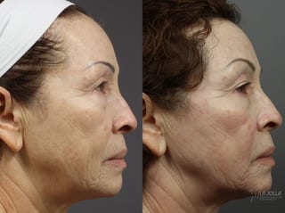 Before and after Fraxel® case 36298 - Angle 1