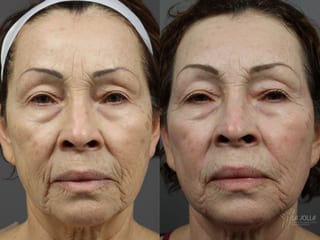 Before and after Fraxel® case 36298 - Angle 2