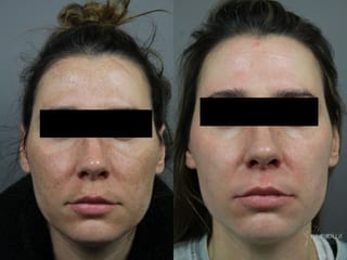 Before and after Chemical Peel case 36299 - Angle 1