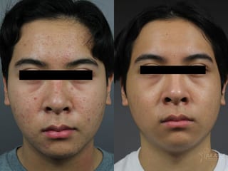 Before and after Chemical Peel case 36300 - Angle 1
