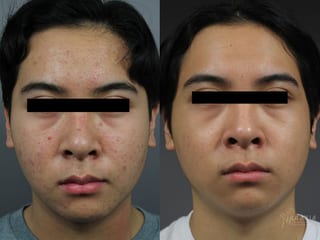 Before and after Fraxel® case 36301 - Angle 1