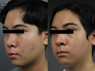 Before and after Fraxel® case 36301 - Angle 2