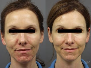 Before and after Acne: Laser Treatment case 36303 - Angle 1