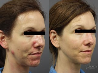 Before and after Acne: Laser Treatment case 36303 - Angle 2