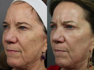 Before and after Ablative Laser Treatment case 36304 - Angle 1