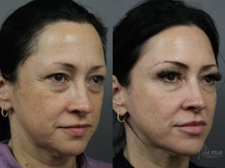 Before and after Sculptra® case 36315 - Angle 1