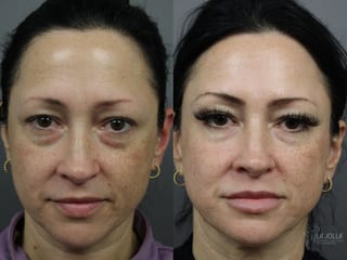 Before and after Sculptra® case 36315 - Angle 2
