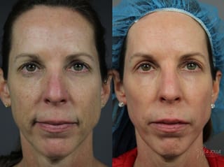 Before and after Fractional CO2 case 36316 - Angle 1