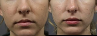 Before and after Lip Filler case 36317 - Angle 1