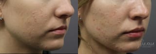 Before and after Lip Filler case 36317 - Angle 2