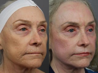Before and after Ablative Laser Treatment case 36318 - Angle 1