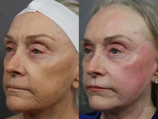 Before and after Ablative Laser Treatment case 36318 - Angle 2